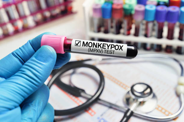 monkeypox cases increasing in delhi